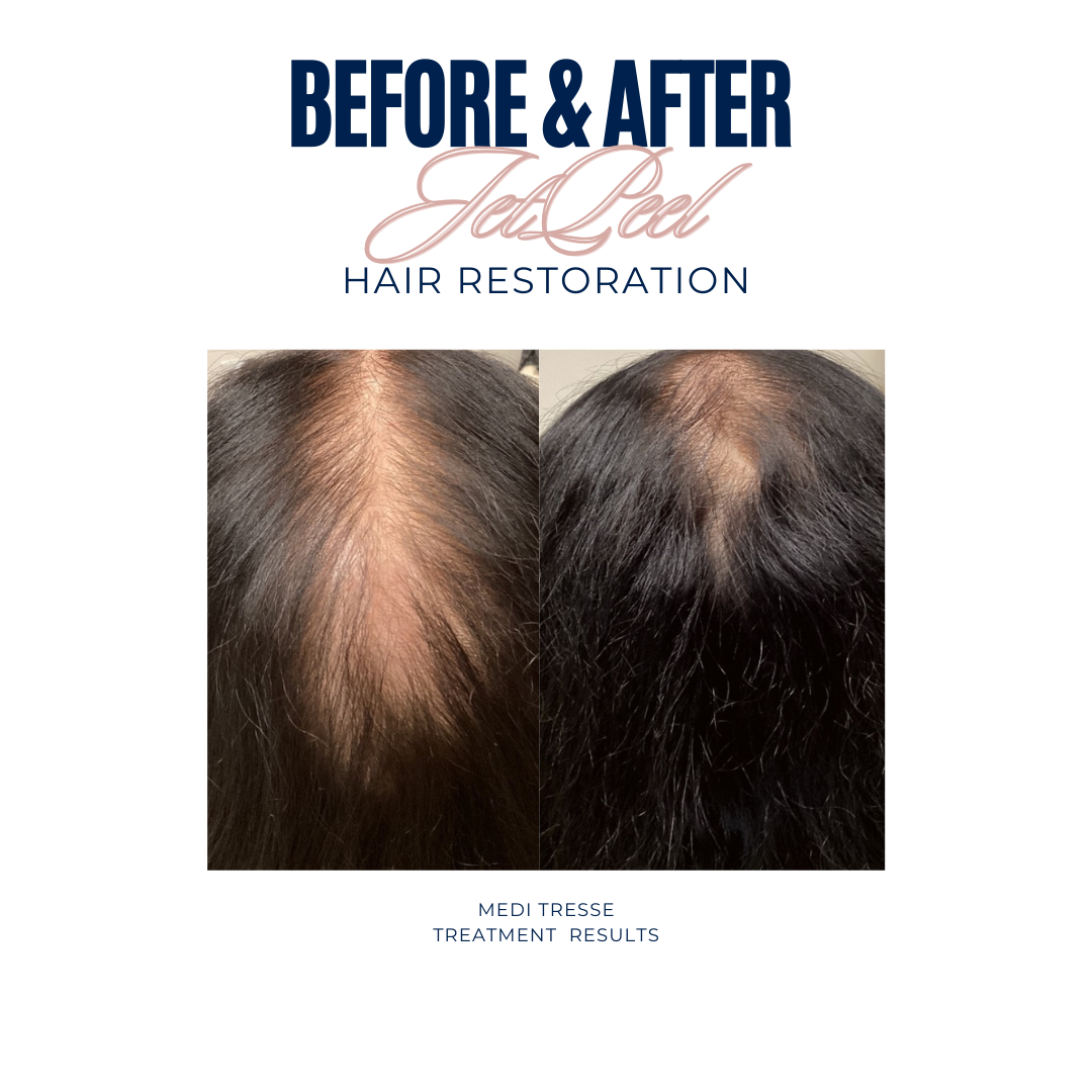 Hair Restoration