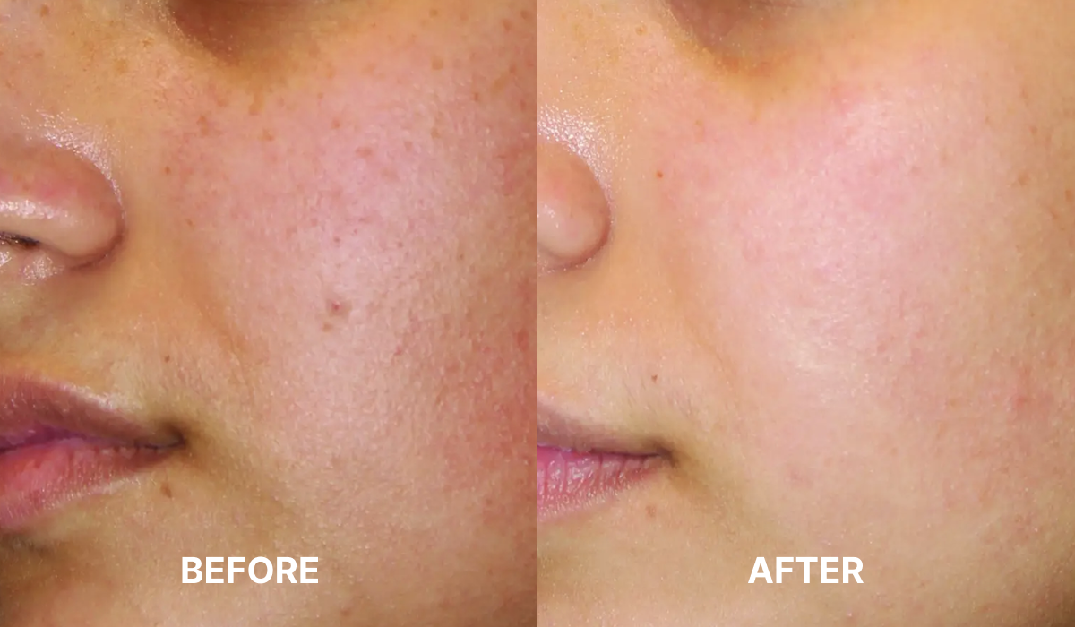 Microneedling