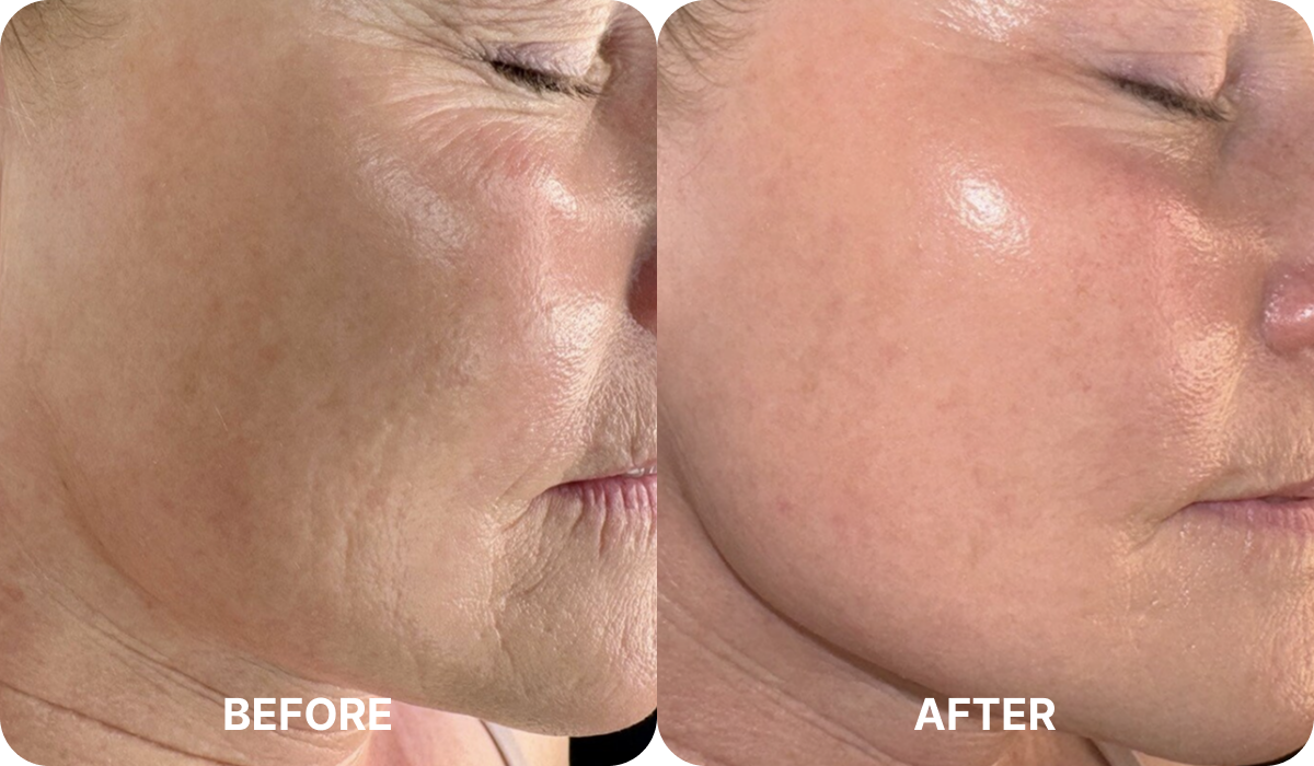 Bombshell Chemical Peel