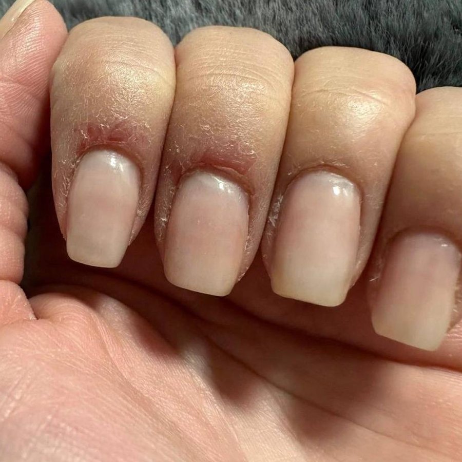 Trockene, eingerissene Nagelhaut nach einem Studiotermin