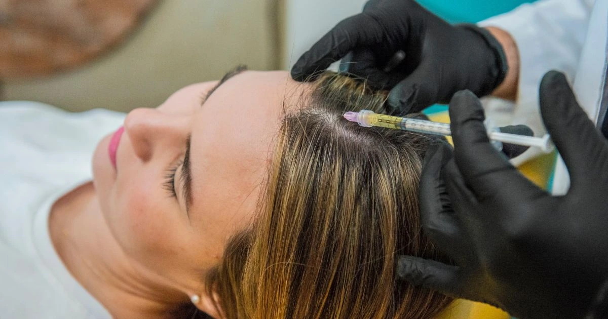 PRP hair restoration scalp treatment at Fernanda Body Aesthetic