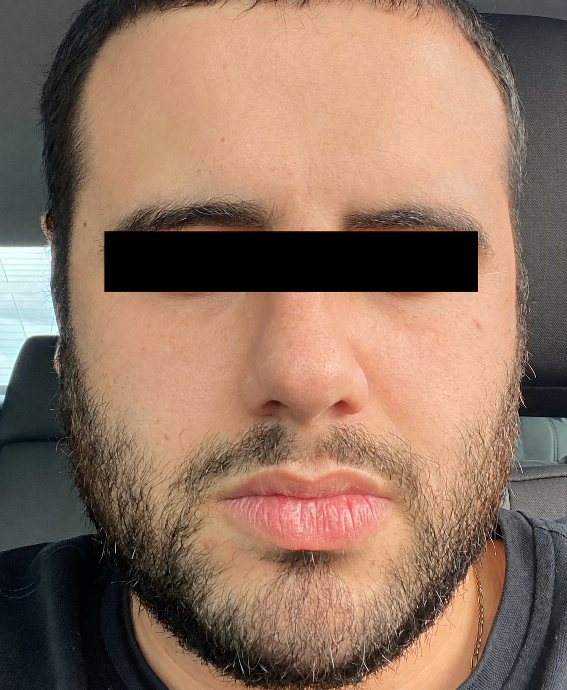 Result After