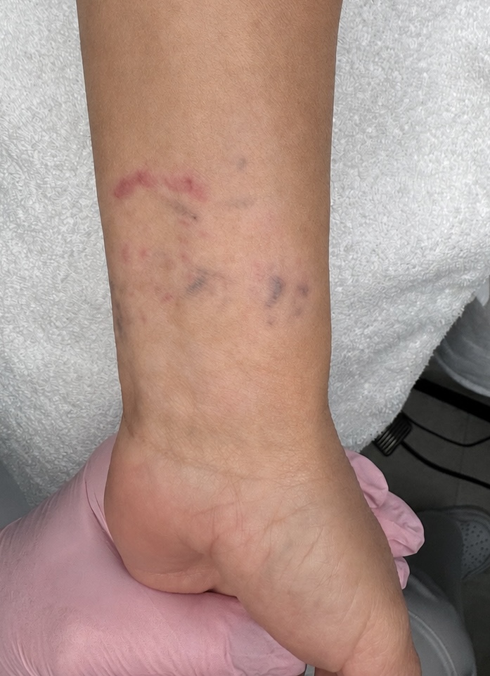 Laser tattoo removal treatment progress
