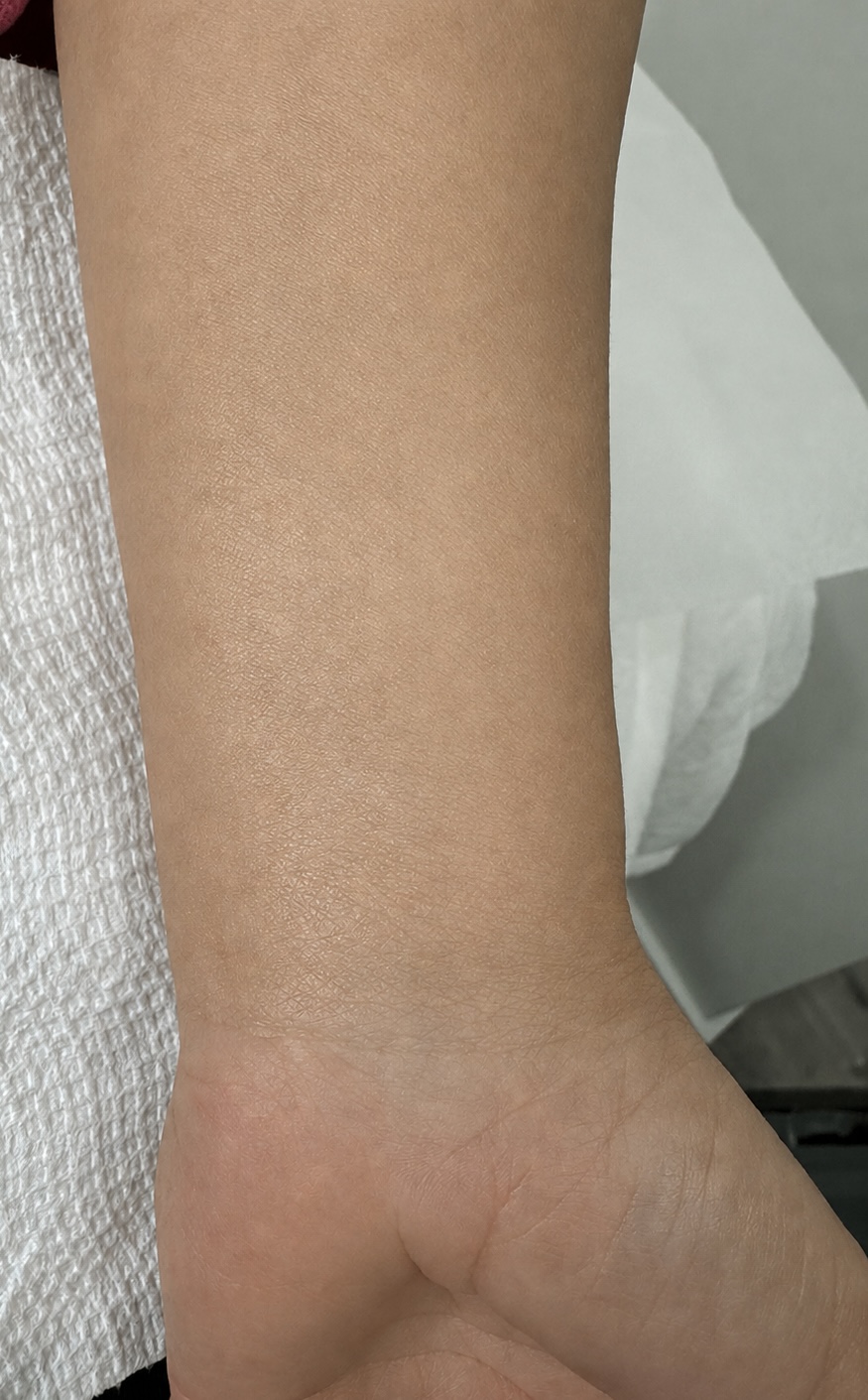 After laser tattoo removal treatment