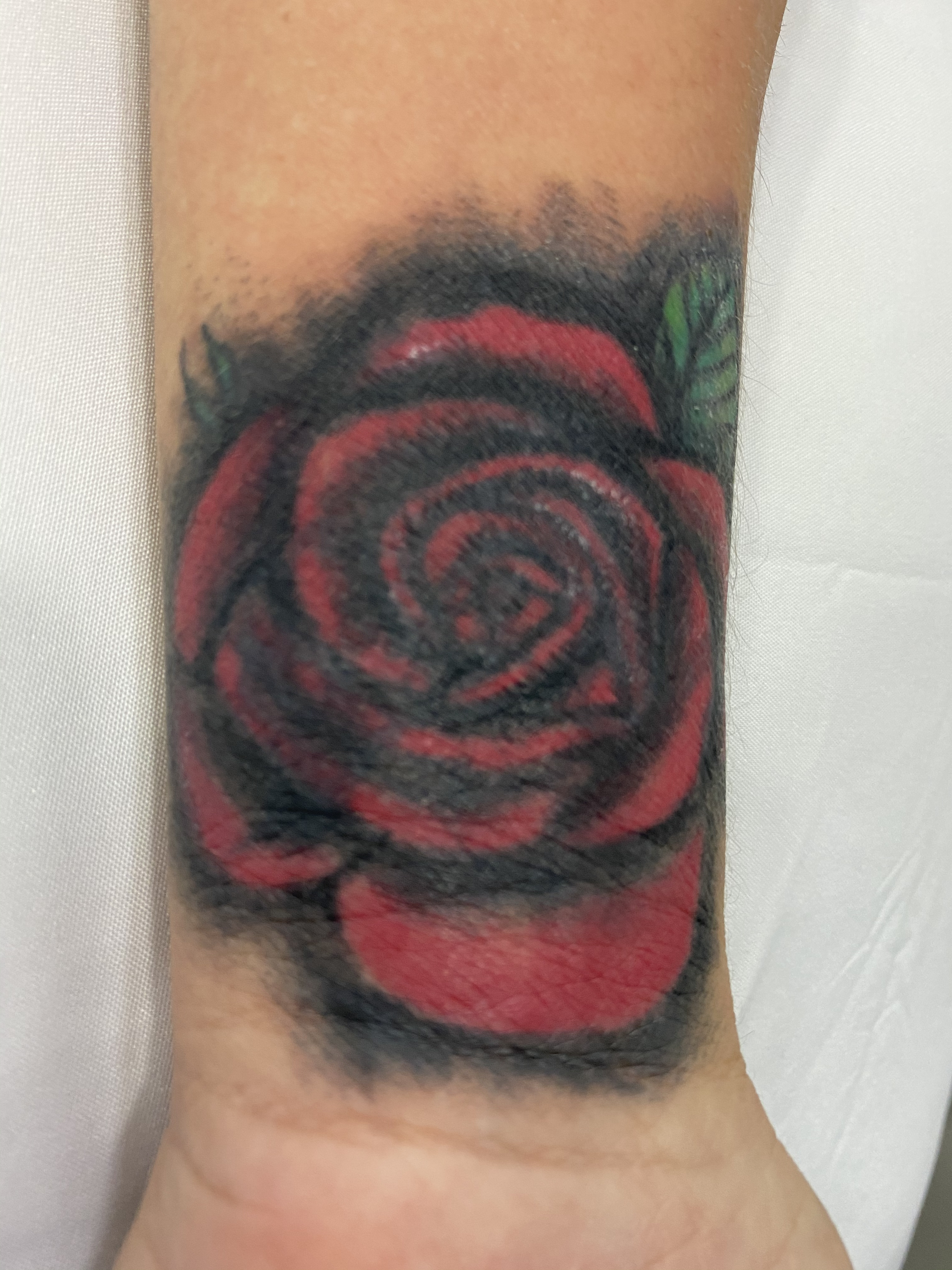 Before laser tattoo removal treatment