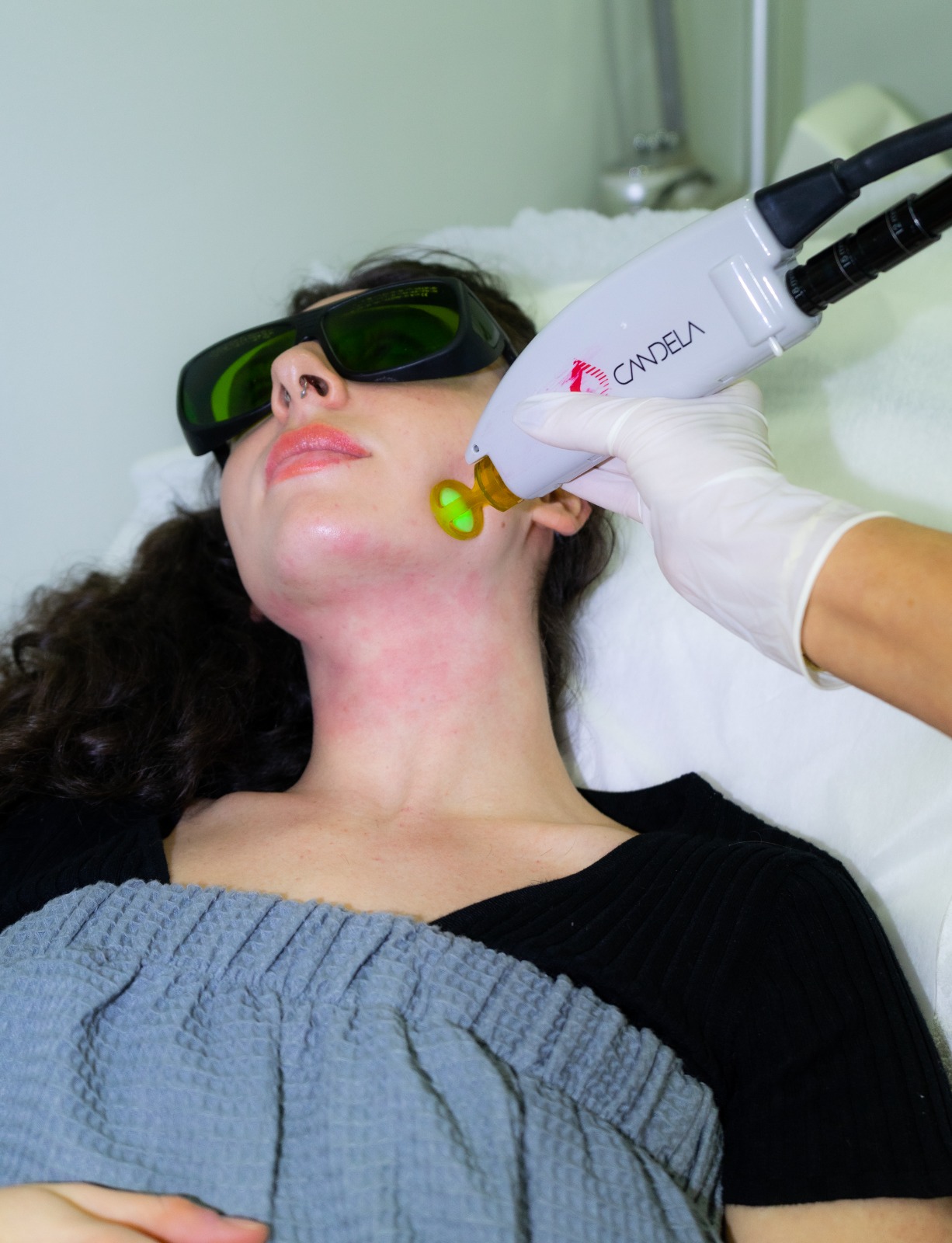 Laser Hair Removal Laser Hair Removal at Idealaser Miami