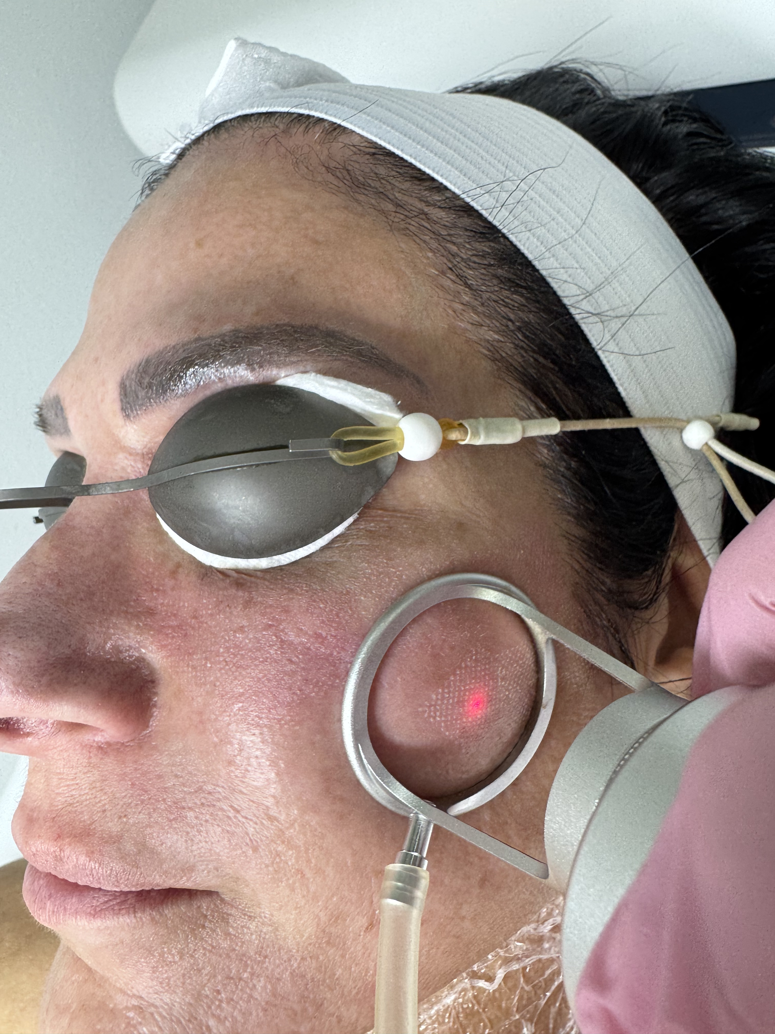 CO2 Laser Resurfacing CO2 Laser Resurfacing at Idealaser Miami
