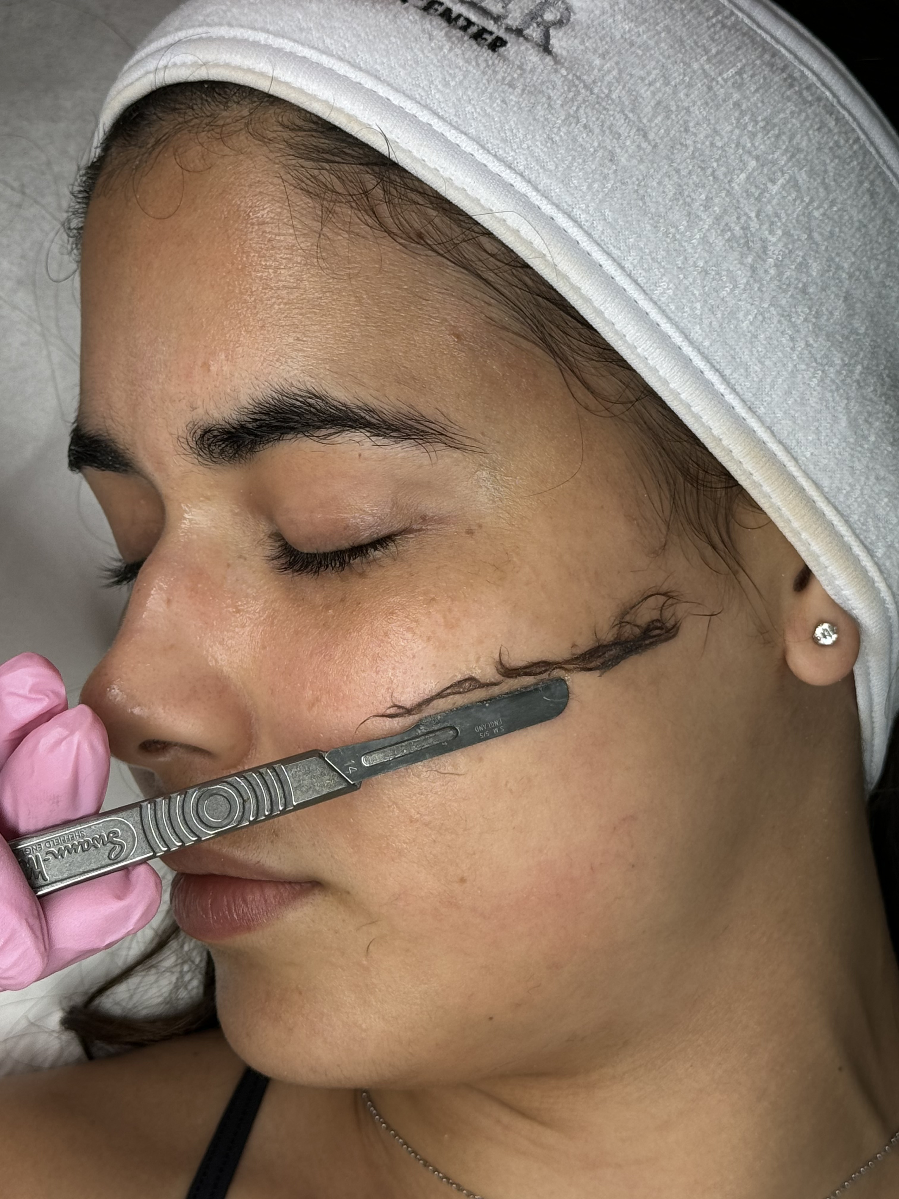 Dermaplaning Dermaplaning at Idealaser Miami