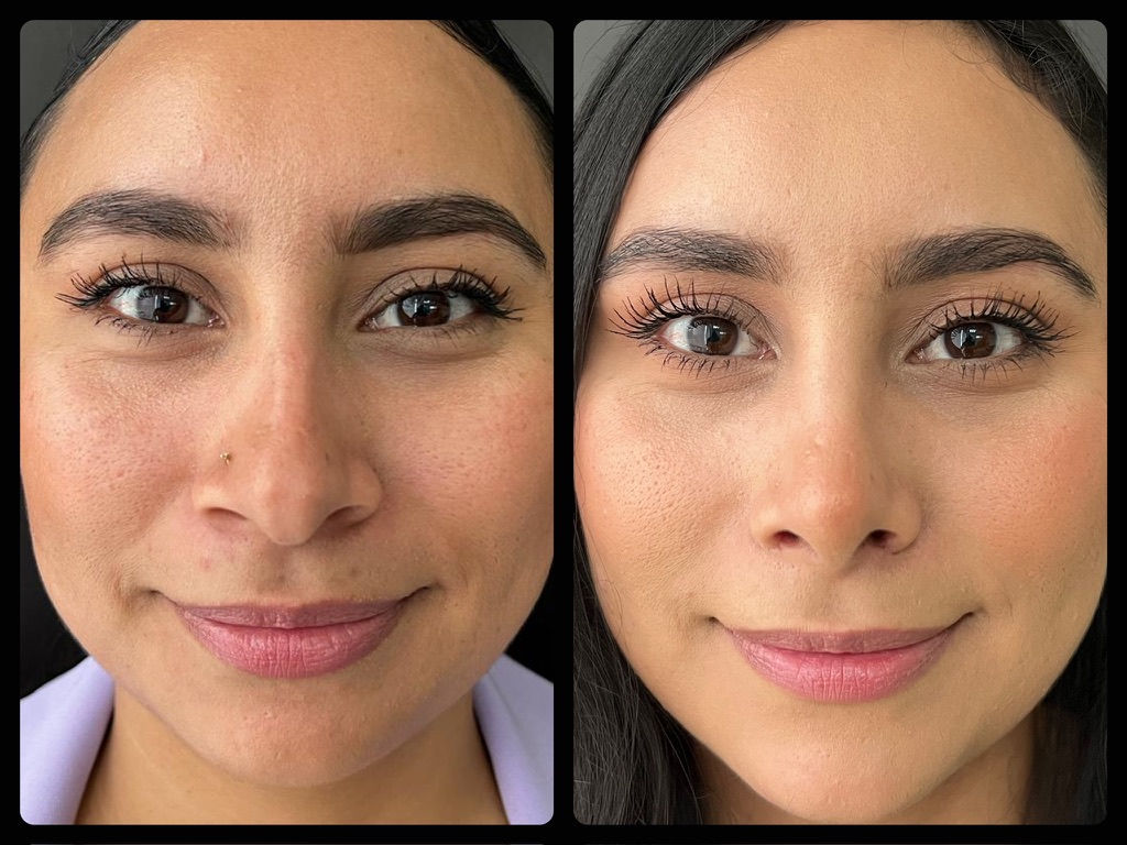 Armonización facial