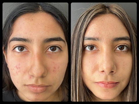 Rinoplastia y mentoplastia retrognatia frontal