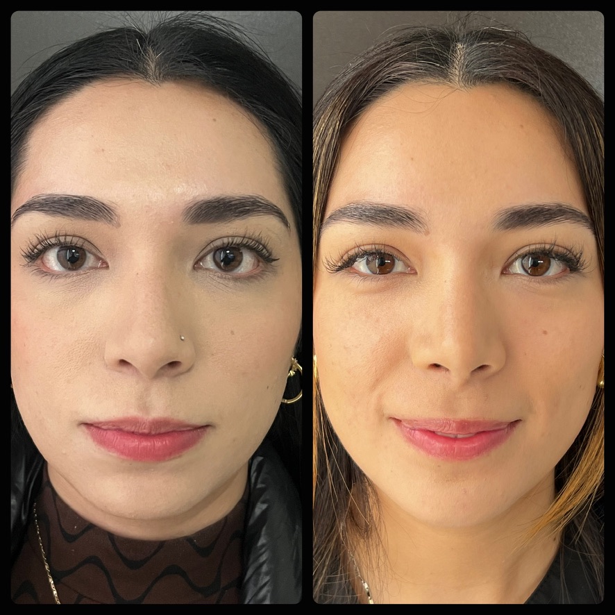Rinoplastia bichectomía mentoplastia