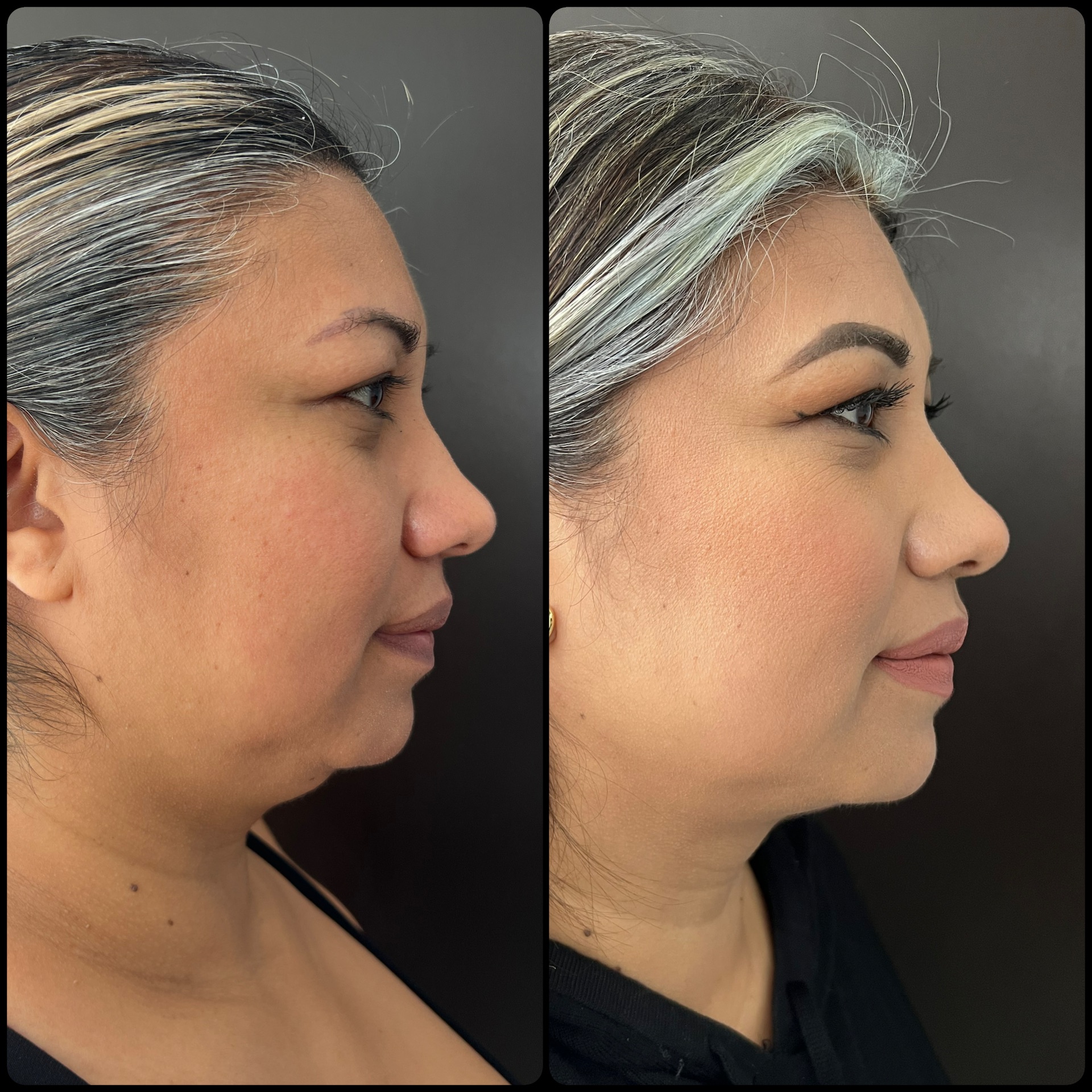 Endolifting láser con lipoescultura de cuello
