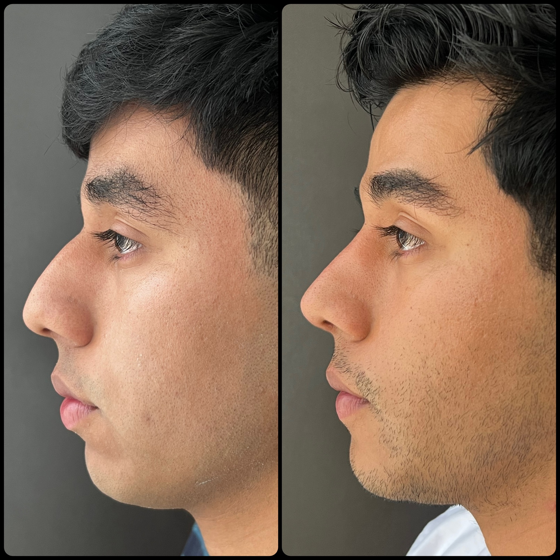 Rinoplastia y mentoplastia masculina