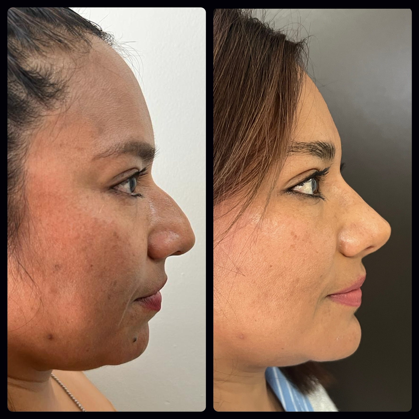 Rinoplastia y mentoplastia perfil