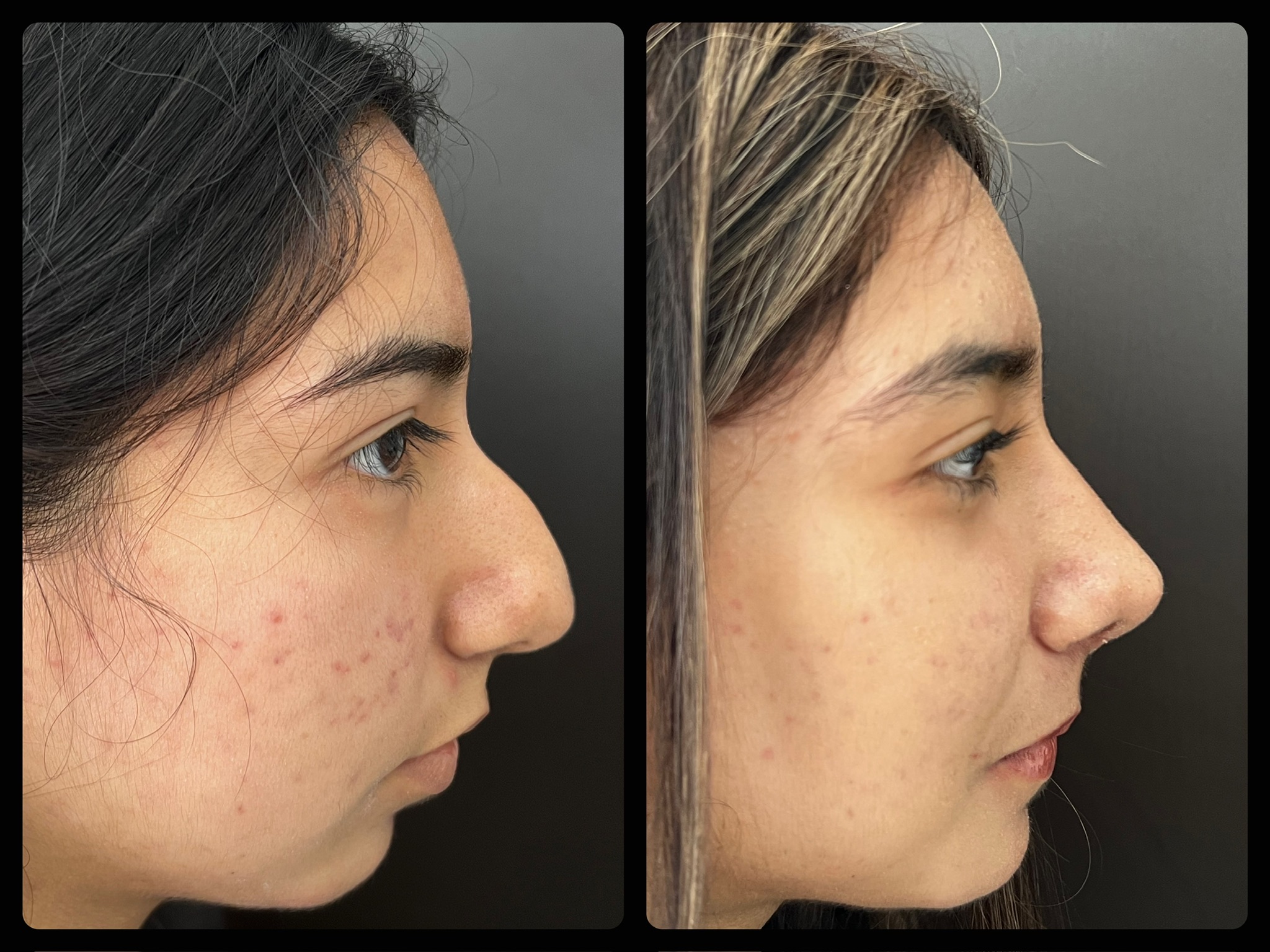 Rinoplastia y mentoplastia retrognátia perfil