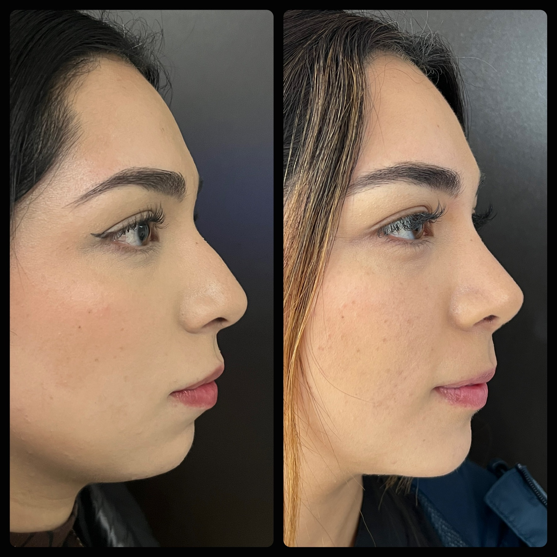 Rinoplastia bichectomía mentoplastia perfil