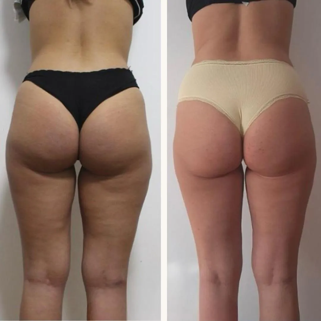 Före och efter Cellulit och Lift på ben och säte