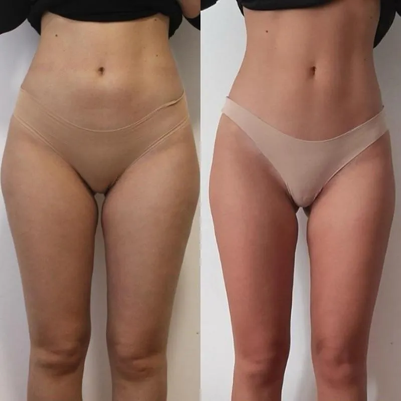 Före och efter Cellulit och Lift på mage och lår