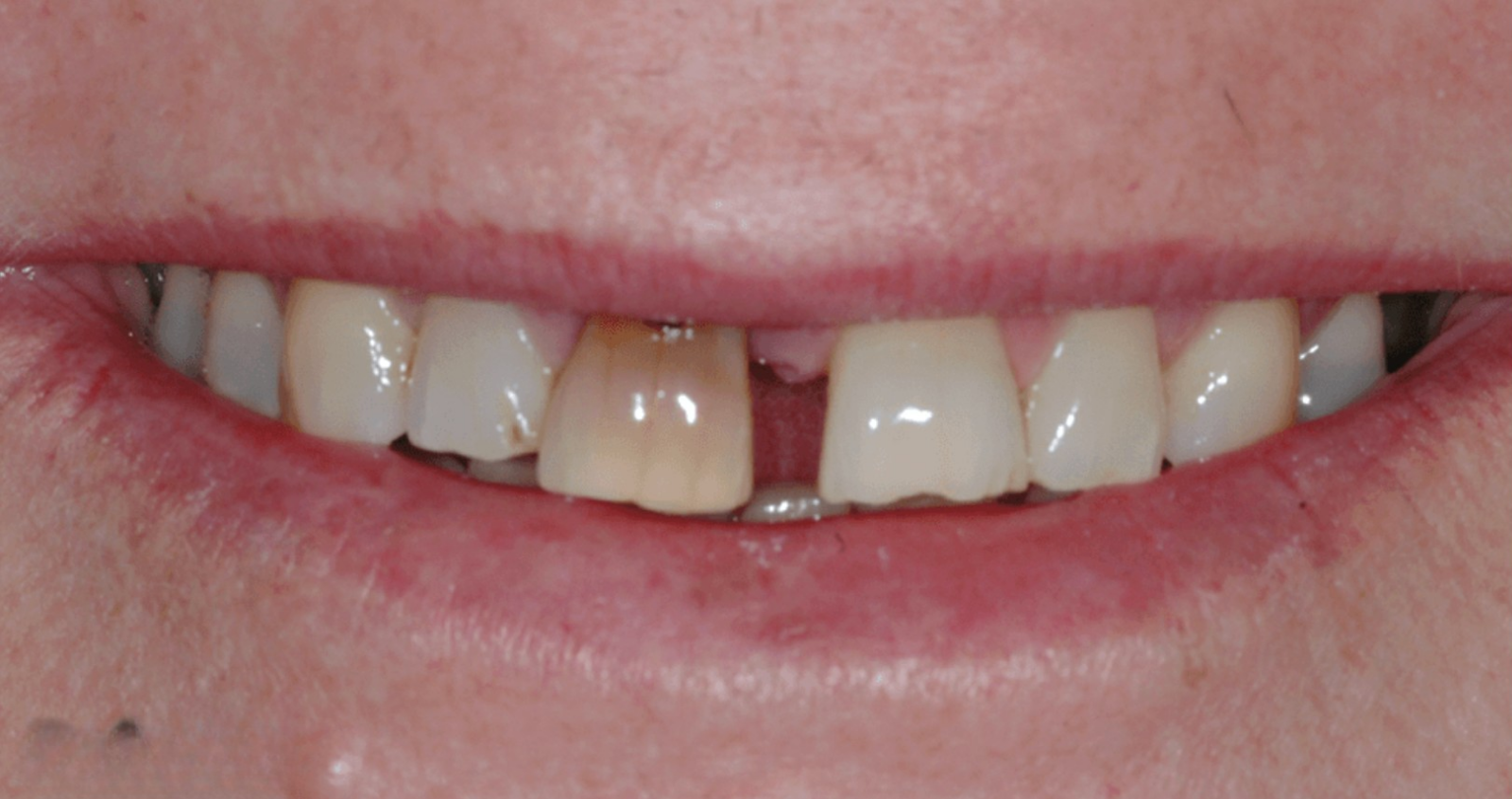 Before treatment