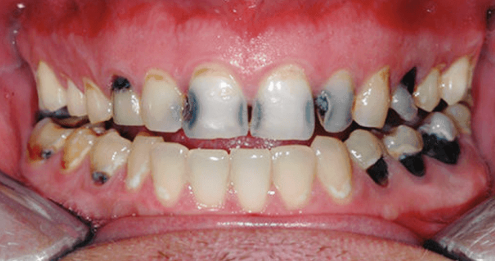 Before treatment