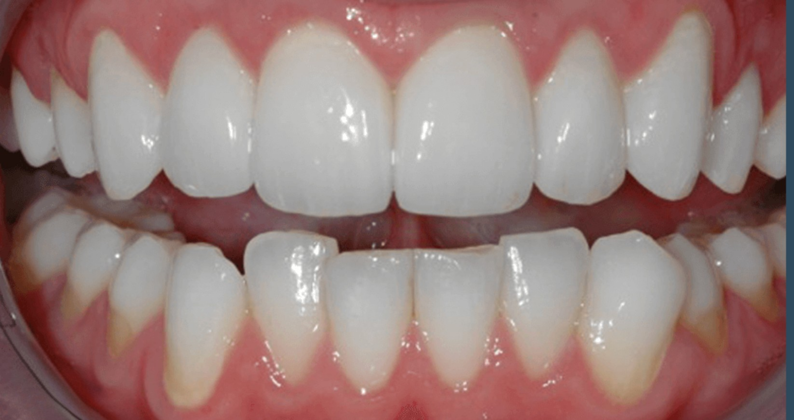 After treatment