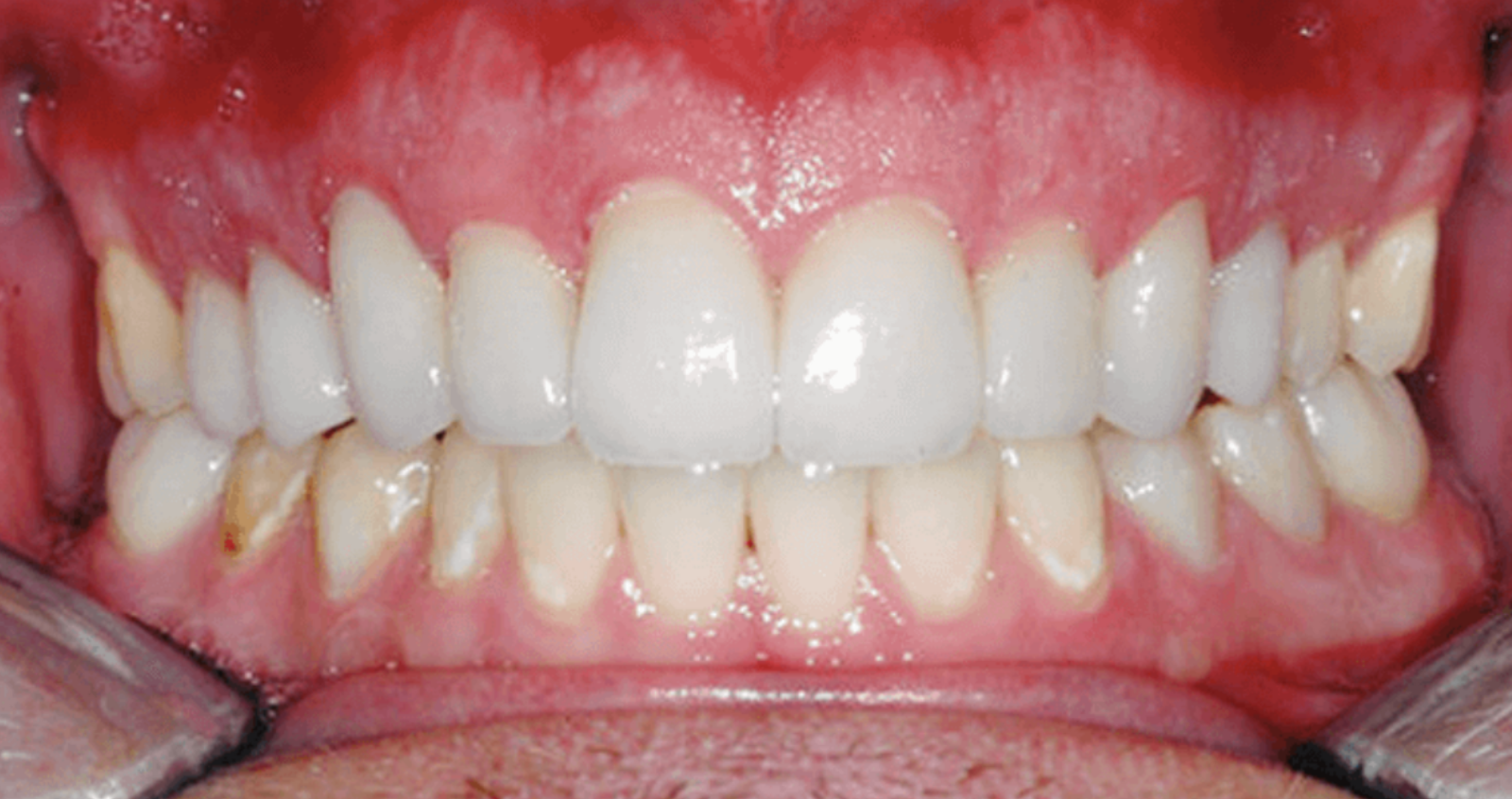After treatment