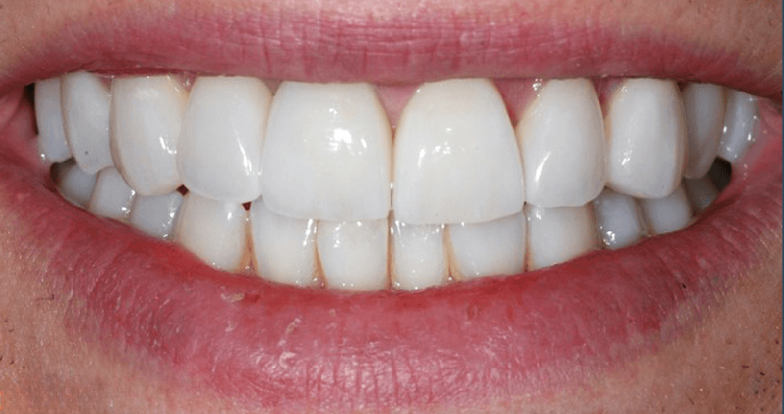 After treatment