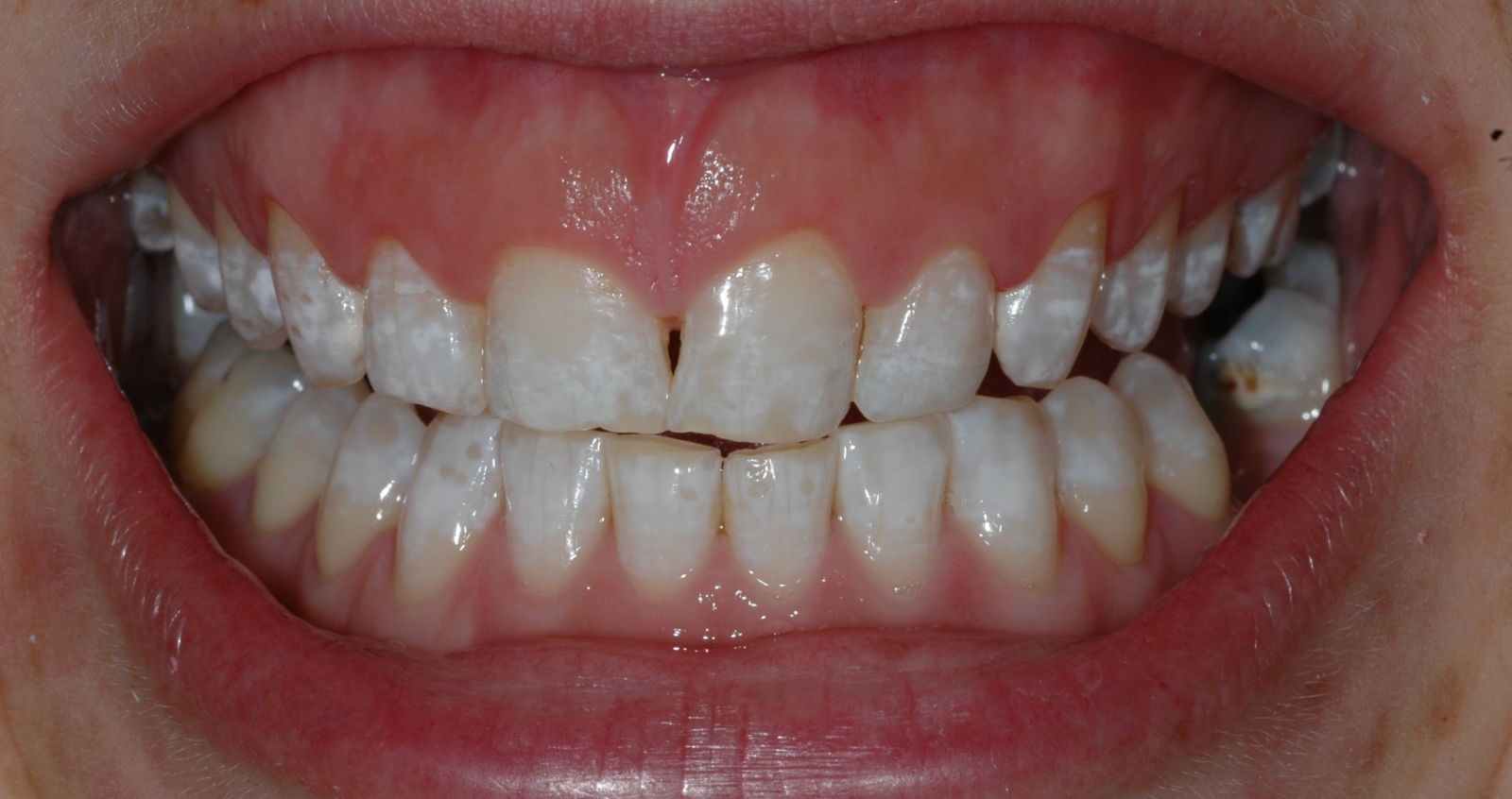 Before treatment