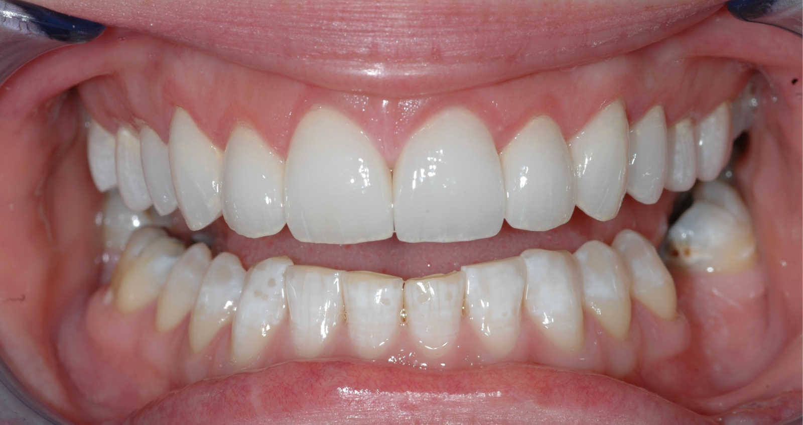 After treatment