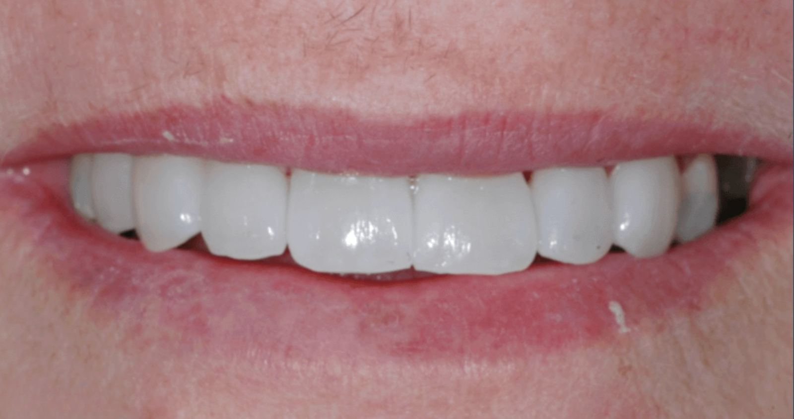After treatment