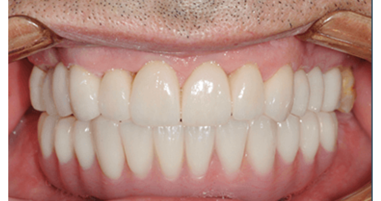After treatment