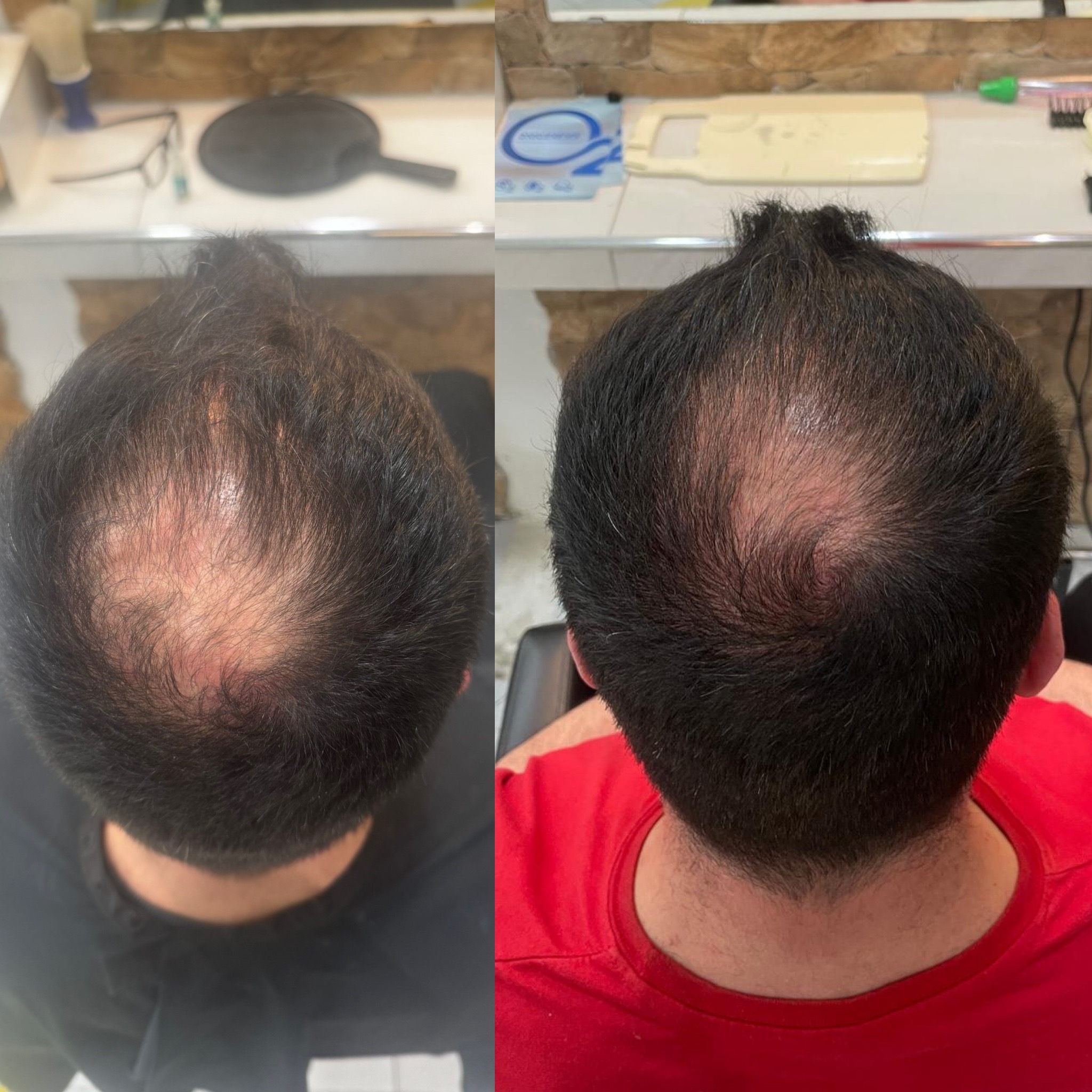 Resultado tratamiento capilar hombre — antes y después
