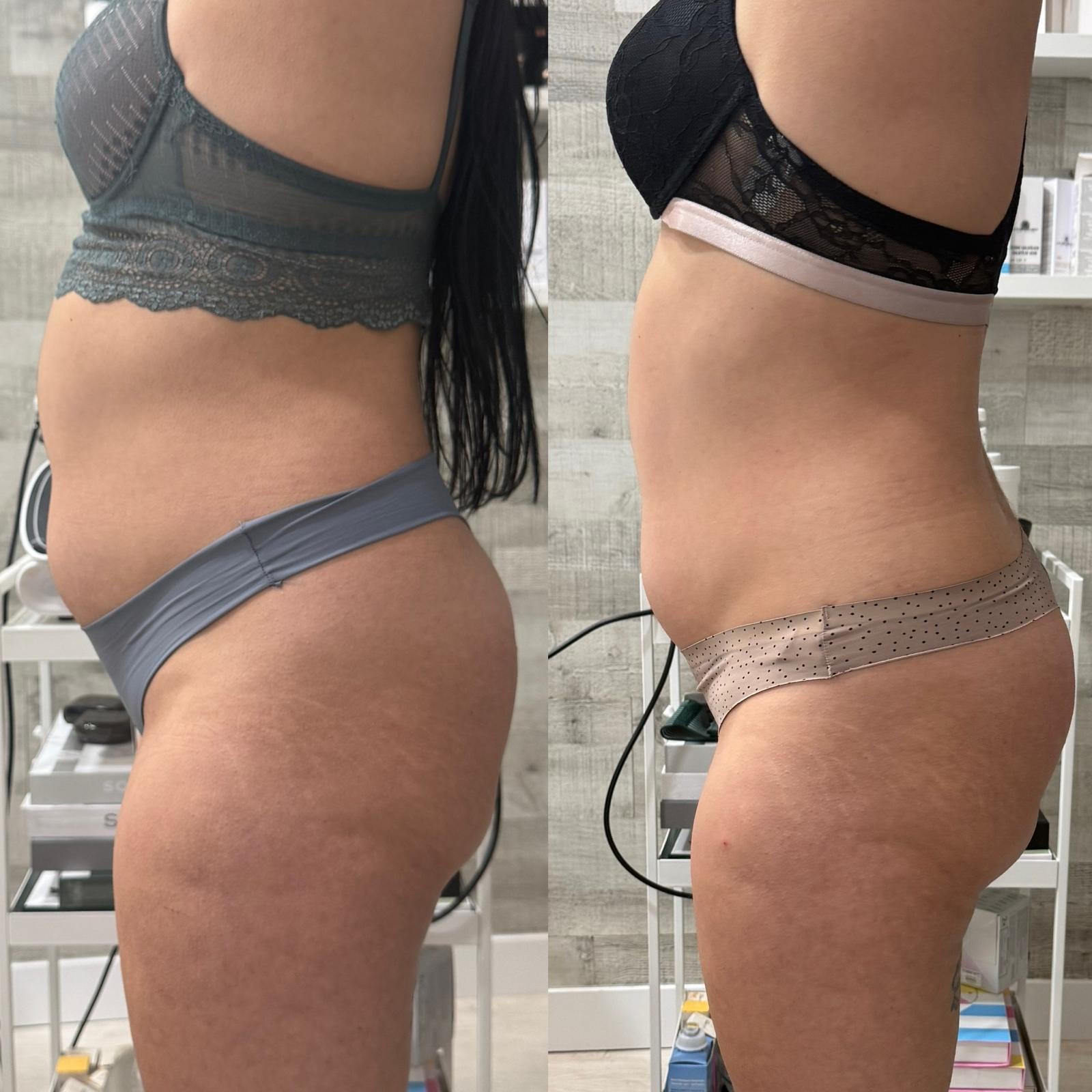 Tratamiento Reset, antes y después