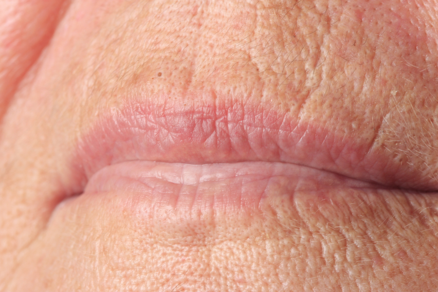 Why Lips Thin With Age