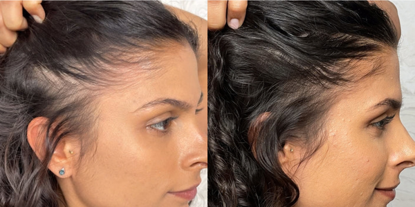 Nulastin Hair Vibrant Scalp Treatment results after 12 weeks Nulastin Hair Vibrant Scalp Treatment results after 12 weeks