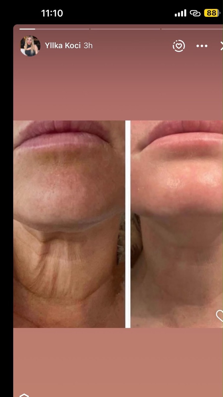Lower face before and after treatment