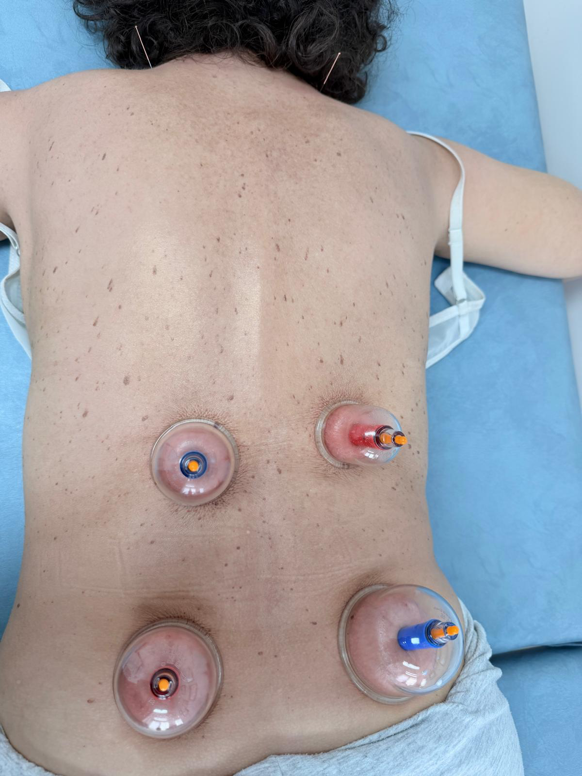 Cupping therapy treatment