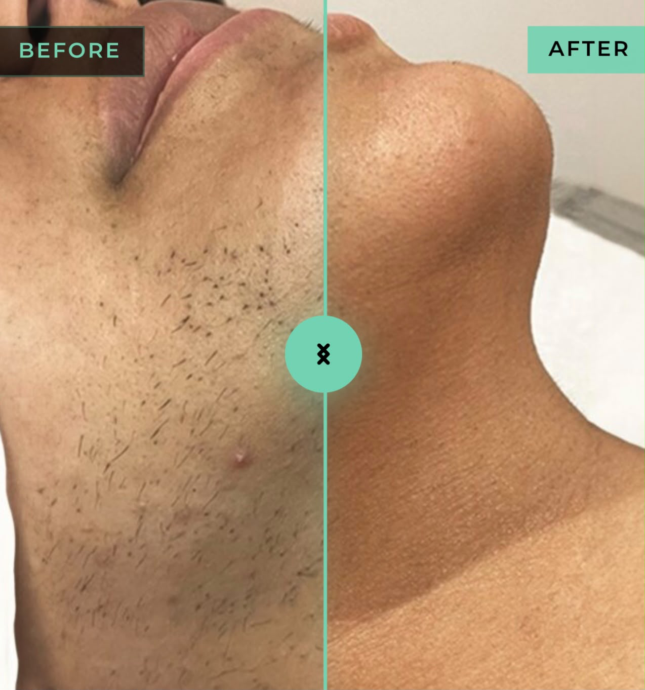 Laser hair removal before and after comparison