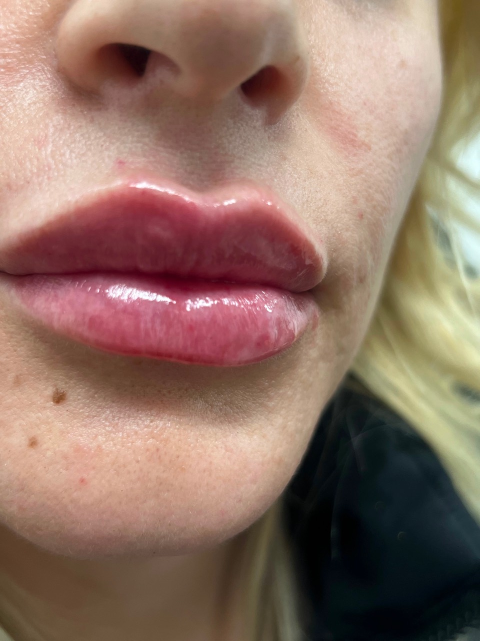 Lip treatment after photo