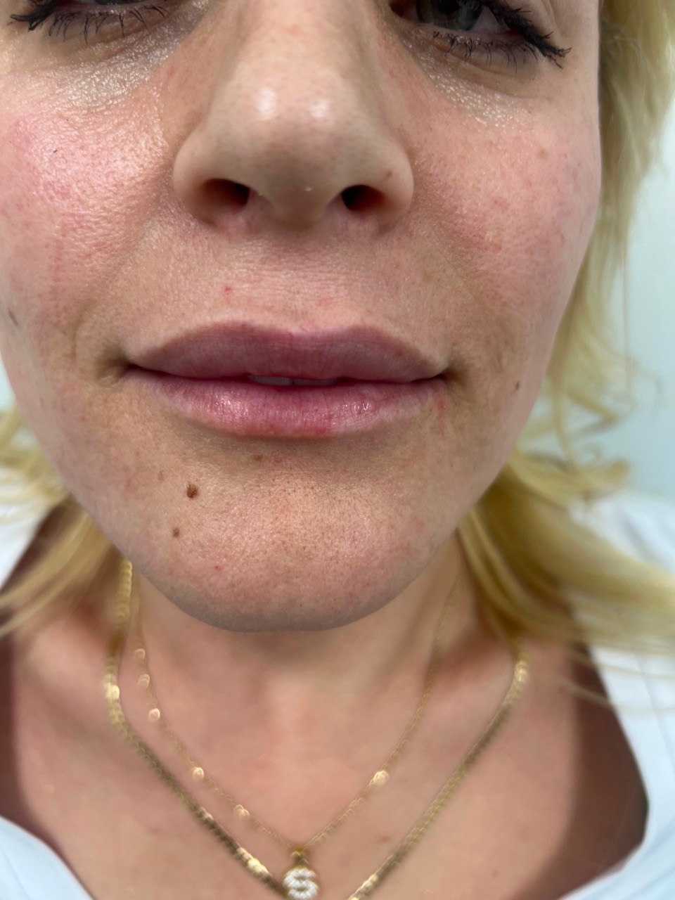 Lip treatment before photo