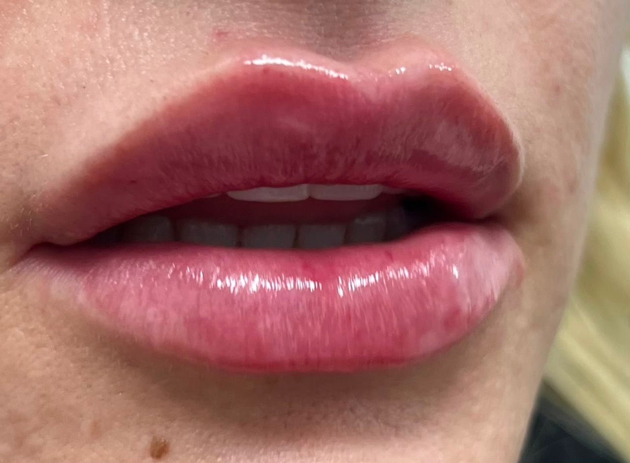Lip result from Star Aesthetics