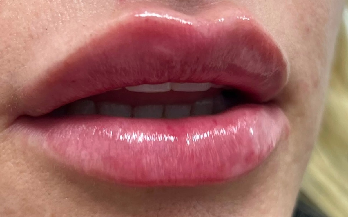After lip treatment comparison