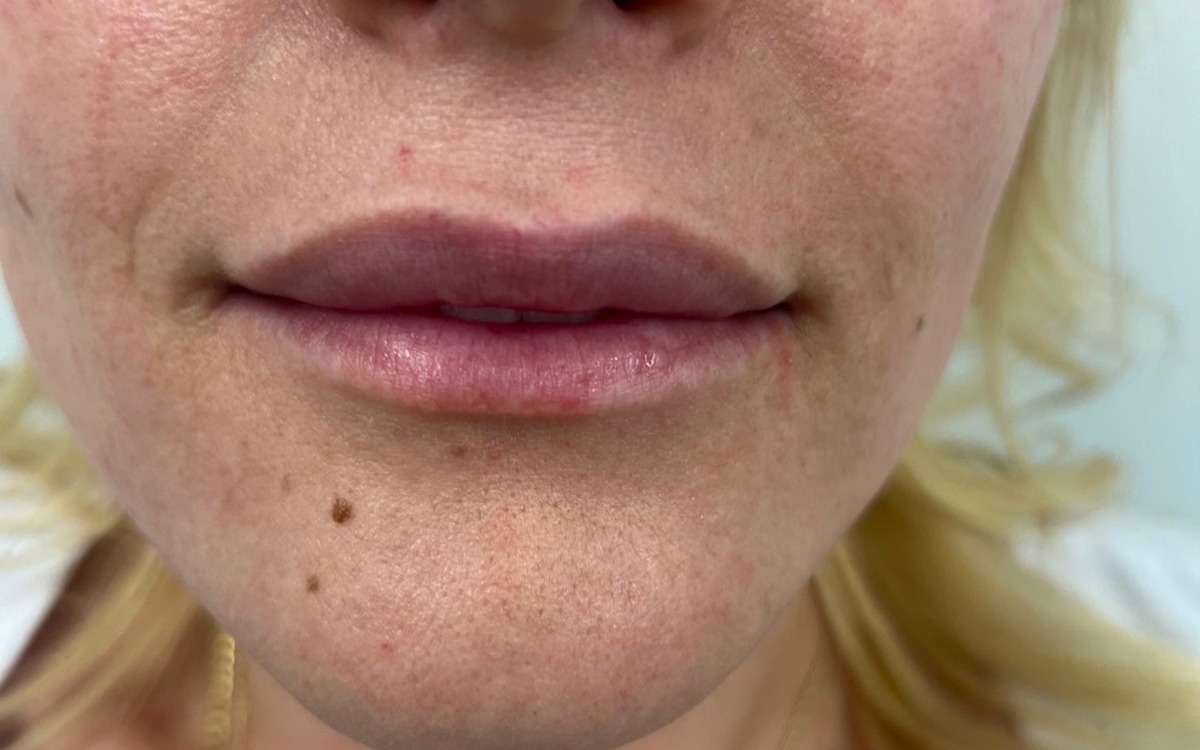 Before lip treatment comparison