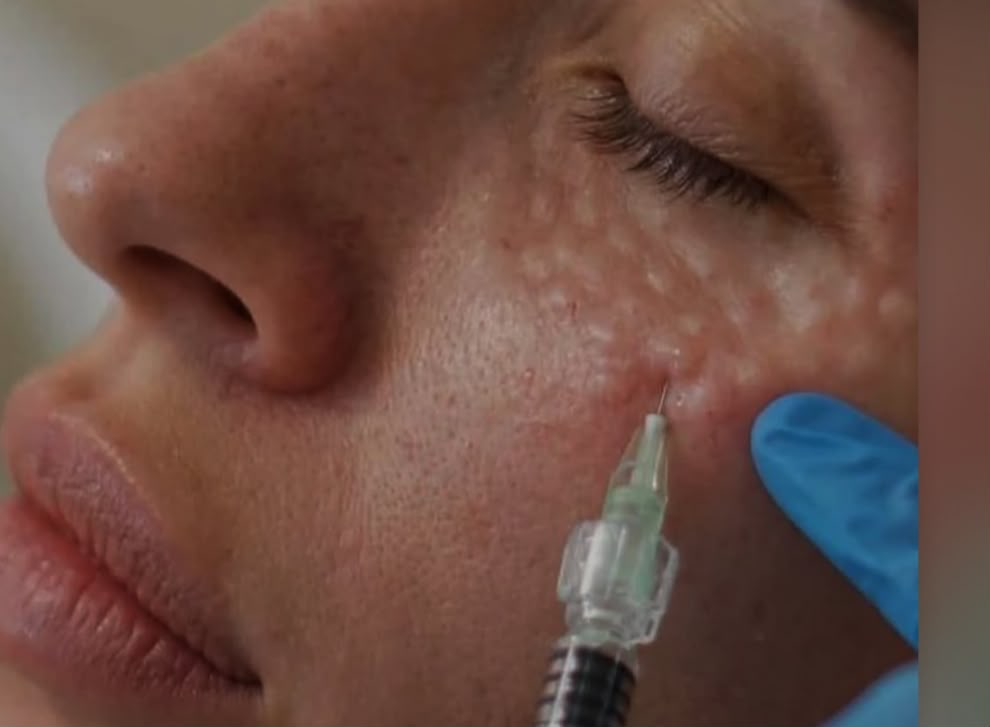Polynucleotide under-eye treatment