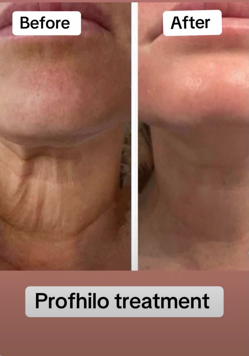 Profhilo before and after result
