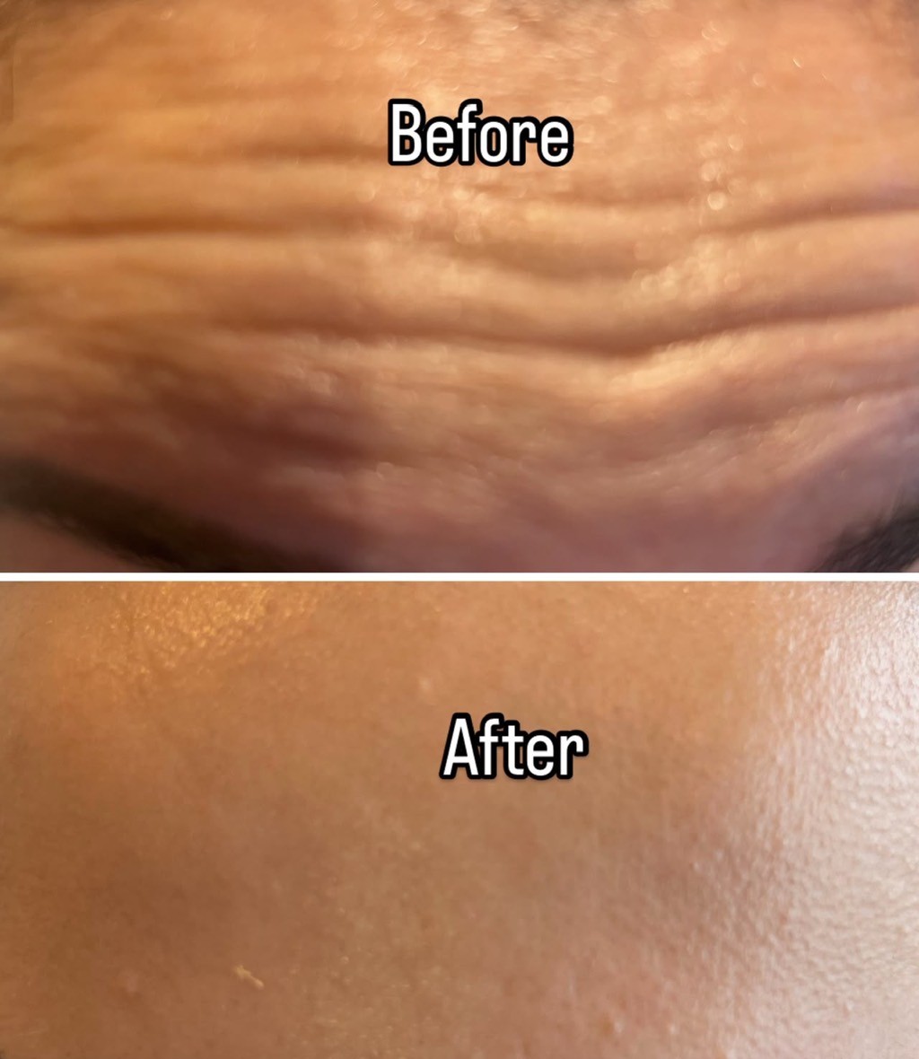 Skin before and after result