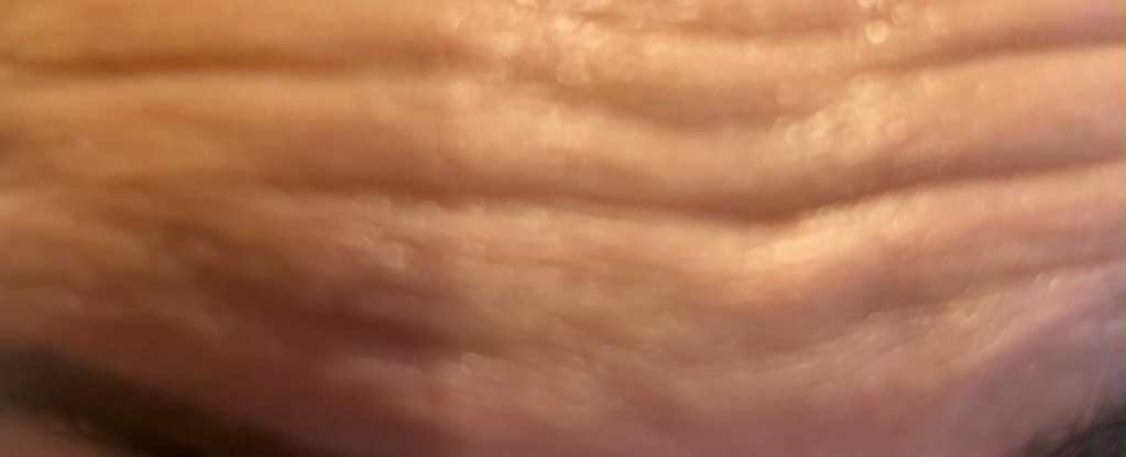 Forehead lines before treatment