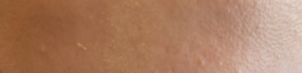 Forehead lines after treatment