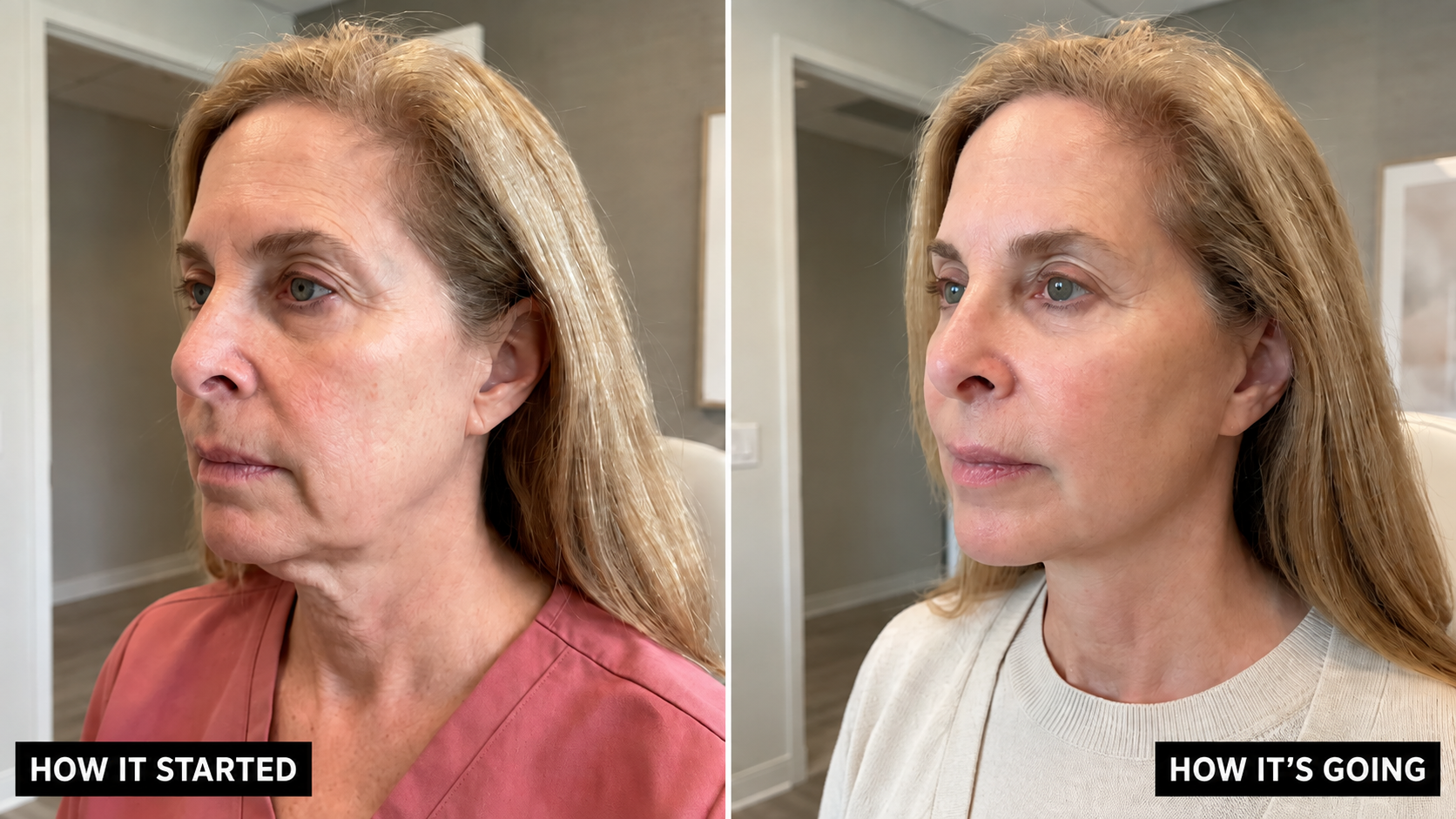 Morpheus8 before and after — jawline lift and contour