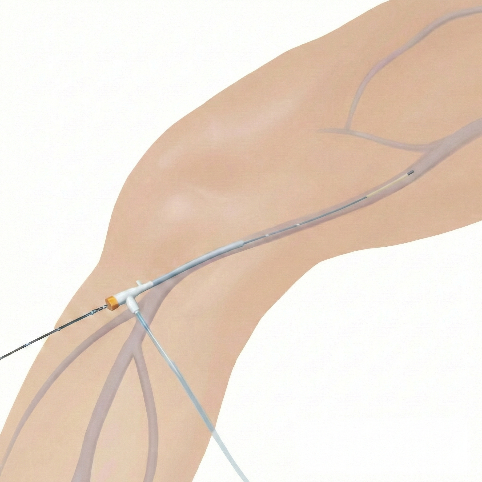 Endovenous Radiofrequency Ablation Procedure for Varicose Veins at Solon Vein Clinic